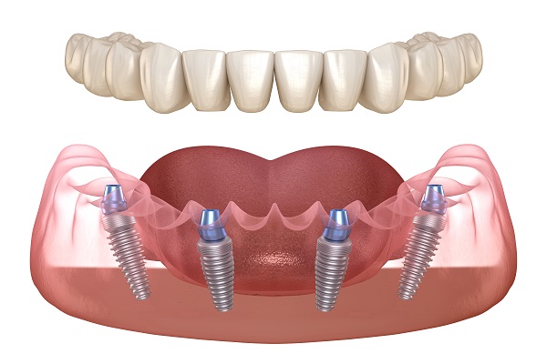What Is All On  ® And How Does It Replace Missing Teeth?