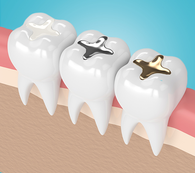 Sylmar Composite Fillings