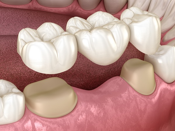How A Dental Bridge Addresses Gaps