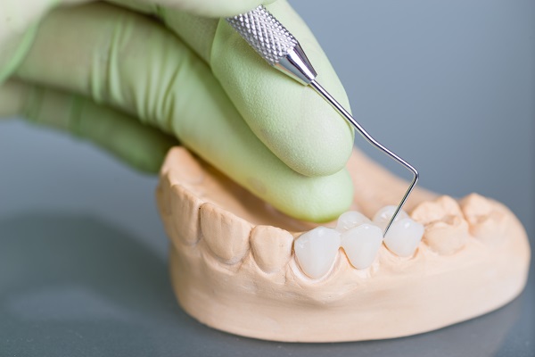 Signs Of A Loose Dental Bridge