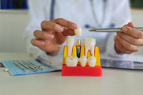 Dental Crown Materials: How To Make The Right Choice For Your Smile