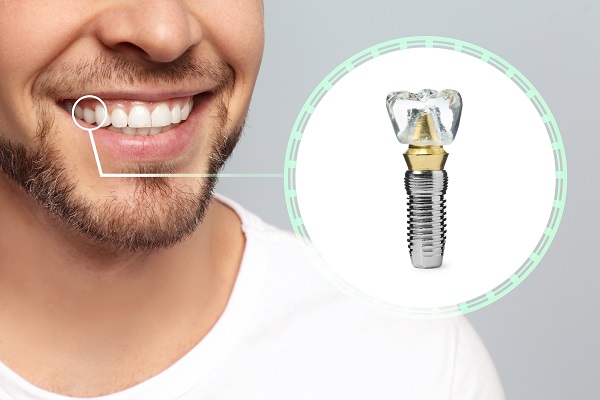 Get A Dental Implant Restoration After Tooth Extraction
