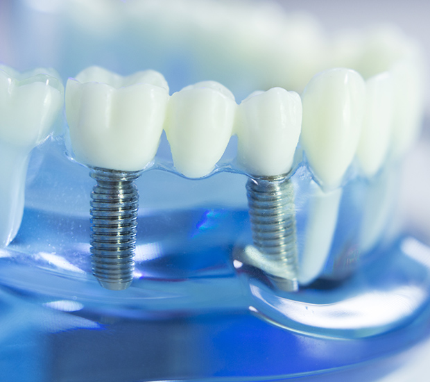 Sylmar Dental Implants